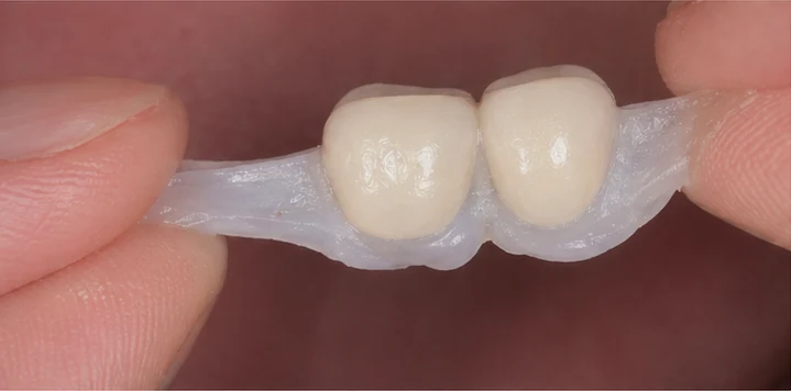 Procédure visuelle de pose et de mise en forme de la prothèse – dent supérieure avec la dent voisine