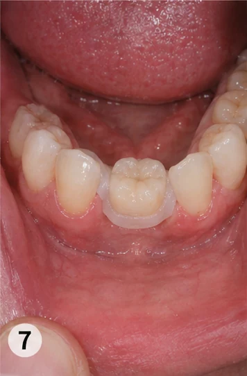Procédure visuelle de pose et de mise en forme de la prothèse – dent supérieure avec la dent voisine