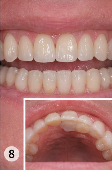 Procédure visuelle de pose et de mise en forme de la prothèse – dent supérieure avec la dent voisine