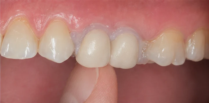 Guide visuel – dent supérieure manquante avec les dents adjacentes