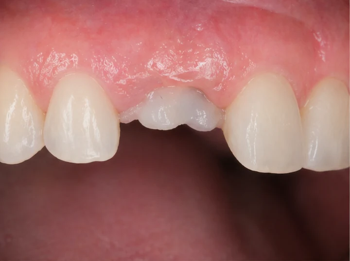 Procédure Denticor pour une canine : espace comblé, couronne en DentiFlex, insertion entre les dents et un pont définitif fin