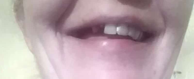 Cliente – dent de devant cassée, avant la pose de Denticor
