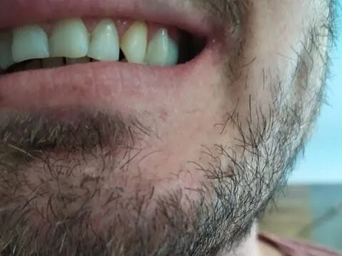 Dent latérale complétée par une prothèse Denticor, vue de profil