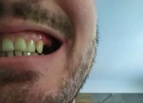 Dent latérale manquante avant l’utilisation de Denticor, vue de profil