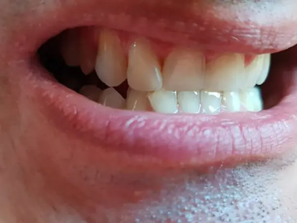 Dents antérieures restaurées à l'aide d'une prothèse provisoire Denticor