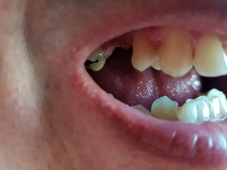 Plusieurs dents antérieures manquantes avant la pose d’une prothèse Denticor