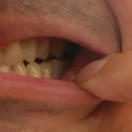 Client – dent inférieure restaurée avec Denticor