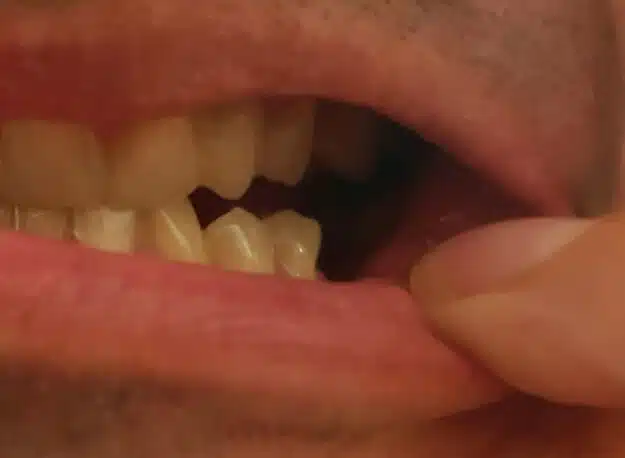 Client – dent inférieure manquante