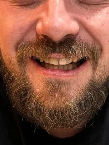 Sourire complet après la restauration d’une dent antérieure avec une prothèse Denticor