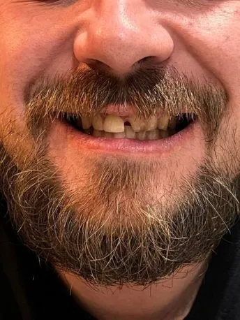 Espace après la dent de devant dans le sourire avant l’utilisation de Denticor
