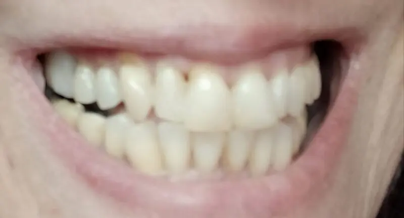 Cliente – espace recouvert de Denticor