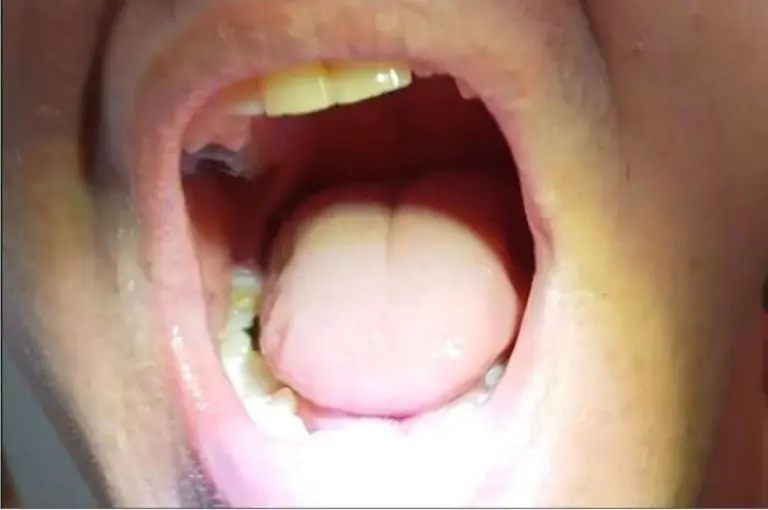 Cliente – dent latérale restaurée avec Denticor