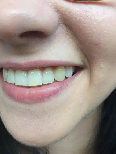 Sourire après la pose d’une nouvelle dent sur mesure Denticor