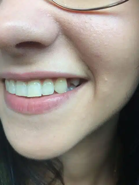 Dent de devant manquante avant la pose d’une prothèse provisoire Denticor