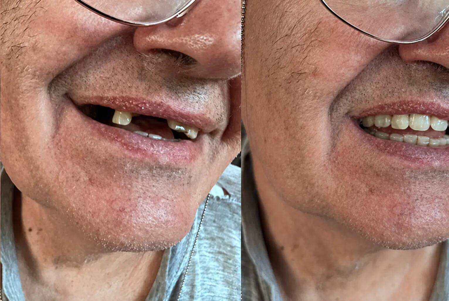 Client – plusieurs dents manquantes avant et après Denticor